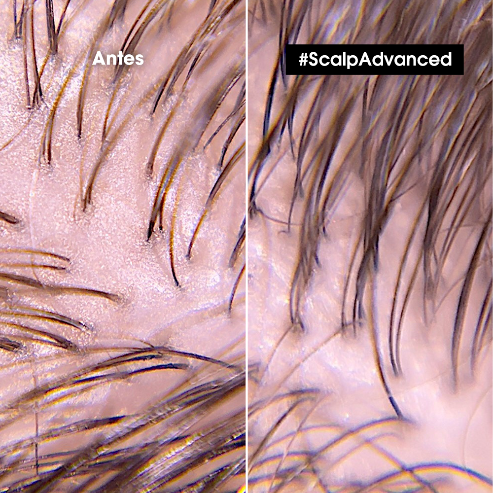 Scalp_advance_shampo_anti_grasa_loreal_serie_expert_john navas_dermotologos_300ml_cuero cabelludo graso_antes_despues
