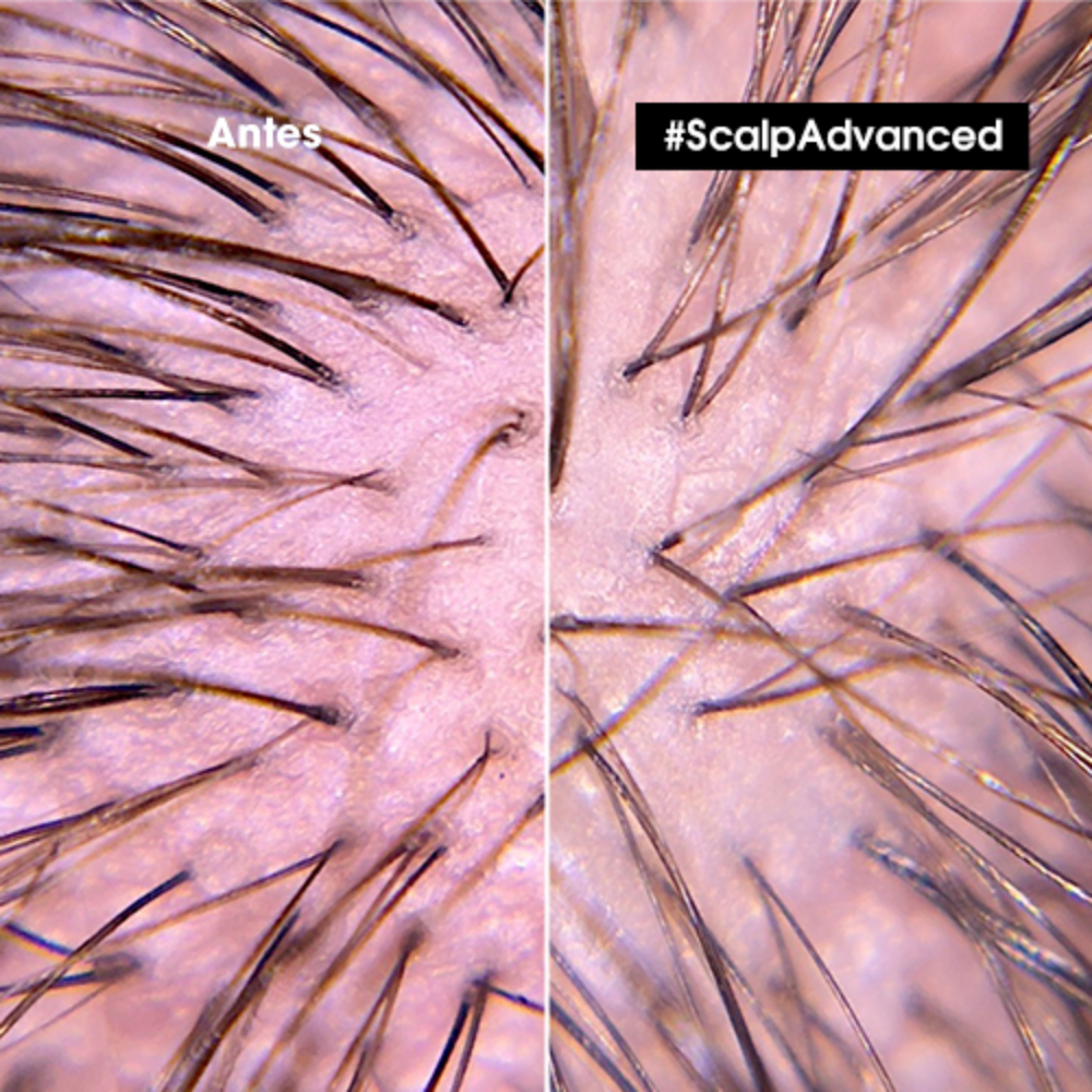 Scalp_advance_shampo_cuero cabelludo sensible_anti_maslestar_loreal_serie_expert_john navas_dermotologos_300ml_antes_despues